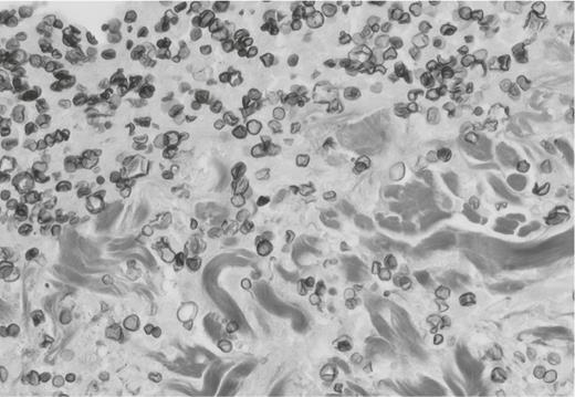 Grocott methenamine silver stain from a single nodule (×40 magnification). Budding yeast cells are visible in the subcutaneous tissue with associated necrotic debris mixed with neutrophils.