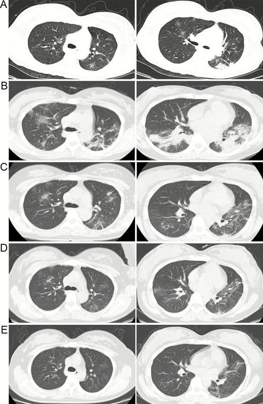Chest computed tomography scans (transverse plane) of the mother. A, 4 February 2020 (2 days before hospitalization). Left-sided subpleural patchy consolidation and right-sided ground-glass opacities. B, 8 February 2020 (hospital day 3, morning). Obvious bilateral multiple ground-glass opacities. C, 12 February 2020 (hospital day 7, postoperative day 4). Bilateral multiple ground-glass opacities, with resolution of infiltrates of both lung fields compared with Figure 1B. D, 15 February 2020 (hospital day 10, postoperative day 7). Bilateral multiple ground-glass opacities. E, 18 February 2020 (hospital day 13, postoperative day 10). Bilateral ground-glass opacities, with resolution compared with panel D.