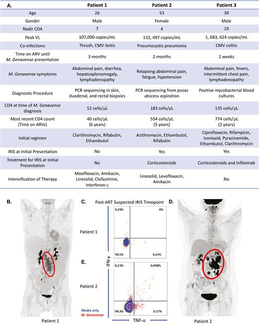 A, Clinical and immunological summaries of patients 1, 2, and 3. B, Protocol mandated abdominal fluorodeoxyglucose–positron emission tomography (FDG-PET) scan imaging of patient 1 to better visualize inflammation as measured by glucose uptake. C, Tumor necrosis factor and interferon-γ production by CD4 T cells of patient 1 after in vitro stimulation with irradiated Mycobacterium genavense. D, Protocol-mandated abdominal FDG-PET scan imaging of patient 2. E, Cytokine production by CD4 T cells of patient 2 after in vitro stimulation with irradiated M. genavense. Peripheral blood mononuclear cells collected at time of presentation were used for in vitro stimulation with irradiated M. genavense in patients 1 and 2 to detect production of cytokines by CD4 T cells. Patient 1 had no evidence of CD4 T-cell cytokine response as shown (response does not exceed that of media alone or background). In contrast, patient 2 had clear evidence of a CD4 T-cell cytokine response when coincubated with M. genavense with an increased cytokine response compared to background. Abbreviations: ART, antiretroviral therapy; ARV, antiretroviral; CMV, cytomegalovirus; IFN-γ, interferon gamma; IRIS, immune reconstitution inflammatory syndrome; PCR, polymerase chain reaction; TNF-α, tumor necrosis factor alpha; VL, viral load.