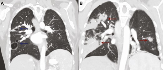Coronal CT scan of the chest (A) demonstrating moderate resolution of previously seen extensive opacities, with 2 remaining cavities in the right middle and upper lobes with associated peripheral nodularity (blue arrows); (B) coronal CT scan of the chest on initial presentation with influenza-related pulmonary aspergillosis demonstrating extensive bilateral opacities (red arrows). Abbreviation: CT, computed tomography.