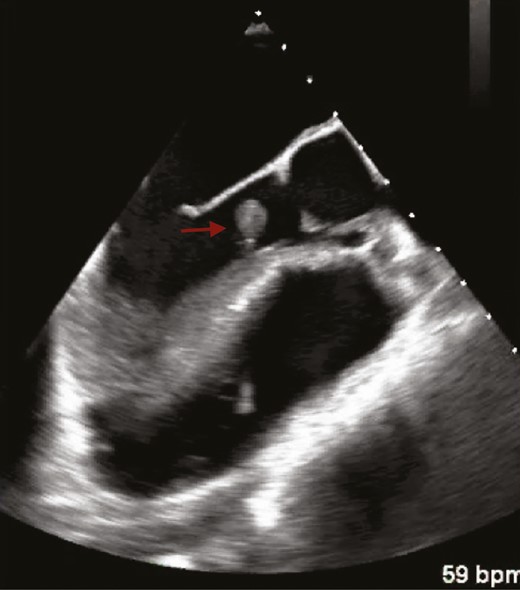Transesophageal echocardiogram demonstrating a 1.4- × 1.2-cm pedunculated mass (red arrow) arising from the left ventricular septum below the aortic valve apparatus consistent with mural endocarditis.