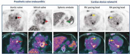 Infective endocarditis of aortic and mitral bioprosthetic valves in a patient with a pacemaker which has been implanted several years ago. At admission, the patient had 1 major criteria (vegetation on mitral valve on transoesophageal echocardiography without lesion on pacemaker leads) and 4 minor criteria (fever, predisposing heart condition, cerebral emboli, a positive blood culture for Staphylococcus epidermidis) (definite IE). The FDG PET/CT scan showed a focal FDG uptake in both aortic and mitral paravalvular areas (red arrows), and a septic emboli in the spleen (green arrows). Extraction of the pacemaker was not initially planned due to the normality of the TEO and the unique positive blood culture. However, an infection of the pacemaker has been suggested by focal FDG uptake located on both atrial and ventricular pacing leads (yellow arrows). Duke classification was not modified (definite IE) but the patient’s management modified and the pacing hardware was extracted. Abbreviations: FDG, fluorodeoxyglucose; IE, infective endocarditis; PET/CT, positron emission tomography/ computed tomography.