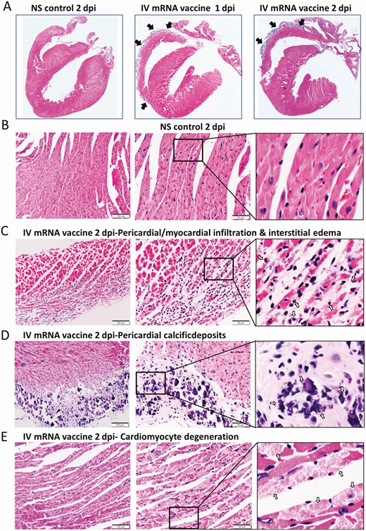 Representative histopathological images of heart tissues of mice receiving IV vaccine. Groups of mice were given IV injection of COVID-19 mRNA vaccine (IV group) and NS (NS group) as control. At 1 and 2 dpi, mice were killed for histopathology analysis. A, Low magnification microscopic scanning images of heart sections (4× magnification). Mice received IV NS showed no detectable histological changes in the heart. After IV mRNA vaccine, the scan images showed thickened and dark blue stained visceral pericardium on the surface of right atrium and right ventricle at both 1 and 2 dpi (arrows). B, H&E stain of heart tissue of IV NS group showed no histological damage in the myocardium and cardiomyocytes. C, H&E stained heart tissue showed inflammatory infiltrates of the myocardium at 2 dpi. Arrows indicated infiltrates of inflammatory cells at 400× magnification. D, H&E stained heart tissue of IV vaccine group at 2 dpi showing thickened visceral pericardium with clusters of dark blue crystal-like structure which indicated calcific deposits (arrows) with adjacent inflammatory cell infiltrates and cardiomyocytes degeneration at. 400× magnification. E, H&E stained myocardial tissue showing cardiomyocytes degeneration at 2 dpi in IV group as indicated by arrows at 400× magnification. F, H&E image showing cardiomyocytes necrosis (arrows at 400× magnification) with immune cells infiltration in IV group at 2 dpi. G, Images of immunohistochemistry staining of white blood cells marker CD45, CD68, and CD3 in the heart sections, showing myocardial and visceral pericardial infiltration by CD45 positive cells. Immunostaining of macrophage marker CD68 showed many positives in the infiltrating cells, with less frequently positive CD3 biomarker for T lymphocytes. Abbreviations: COVID-19, coronavirus disease 2019; dpi, days post-injection; H&E, hematoxylin and eosin; IV, intravenous; mRNA, messenger RNA; NS, normal saline.