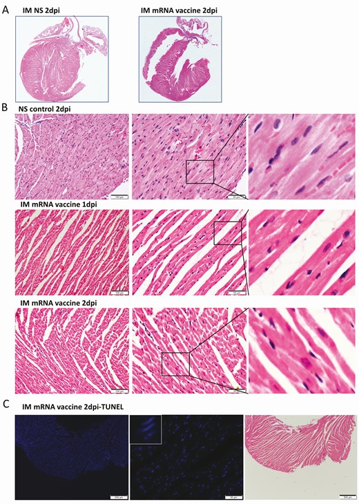 Representative histopathological images of heart tissues after intramuscular administration of mRNA vaccine. Groups of mice were given IM vaccine NS (NS group) as control. At 1–2 dpi, mice were killed for histopathology. A, Low magnification scanning images of heart sections (4× magnification). Both NS group and IM vaccine group showed no histological changes in the heart. B, Representative H&E images of heart tissues. NS groups showed normal myocardium and cardiomyocytes. IM vaccine group showed vascular congestion and mild degree of myocardial edema at 1 dpi. No white blood cell infiltration, cardiomyocyte degeneration, or necrosis was observed. At 2 dpi, vascular congestion was reduced but interstitial edema could still be seen. C, TUNEL staining of heart section showed no positive signal at 2 dpi for IM group. D, H&E images of thigh muscle showed white blood cell infiltration in the connective tissue while the adjacent skeletal muscle cells are unremarkable (magnified image in the right) 1 dpi after IM mRNA vaccine. E, Immunohistochemistry staining of Spike RBD showed only some infiltrating white blood cells expressing spike RBD in thigh muscle of IM group (arrows in magnified images). Abbreviations: dpi, days post-injection; H&E, hematoxylin and eosin; IM, intramuscular; IV, intravenous; mRNA, messenger RNA; NS, normal saline; RBD, receptor binding domain; TUNEL, terminal deoxynucleotidyl transferase dUTP nick end labeling.