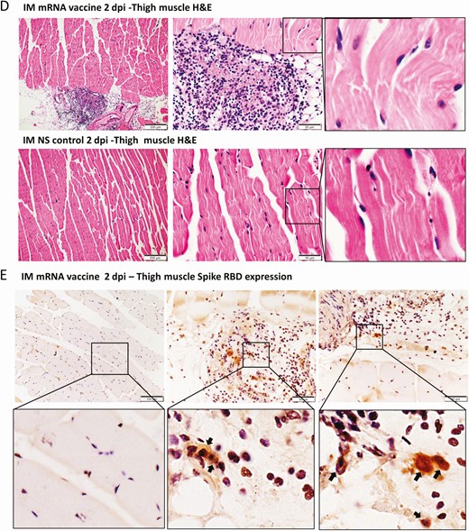 Representative histopathological images of heart tissues after intramuscular administration of mRNA vaccine. Groups of mice were given IM vaccine NS (NS group) as control. At 1–2 dpi, mice were killed for histopathology. A, Low magnification scanning images of heart sections (4× magnification). Both NS group and IM vaccine group showed no histological changes in the heart. B, Representative H&E images of heart tissues. NS groups showed normal myocardium and cardiomyocytes. IM vaccine group showed vascular congestion and mild degree of myocardial edema at 1 dpi. No white blood cell infiltration, cardiomyocyte degeneration, or necrosis was observed. At 2 dpi, vascular congestion was reduced but interstitial edema could still be seen. C, TUNEL staining of heart section showed no positive signal at 2 dpi for IM group. D, H&E images of thigh muscle showed white blood cell infiltration in the connective tissue while the adjacent skeletal muscle cells are unremarkable (magnified image in the right) 1 dpi after IM mRNA vaccine. E, Immunohistochemistry staining of Spike RBD showed only some infiltrating white blood cells expressing spike RBD in thigh muscle of IM group (arrows in magnified images). Abbreviations: dpi, days post-injection; H&E, hematoxylin and eosin; IM, intramuscular; IV, intravenous; mRNA, messenger RNA; NS, normal saline; RBD, receptor binding domain; TUNEL, terminal deoxynucleotidyl transferase dUTP nick end labeling.