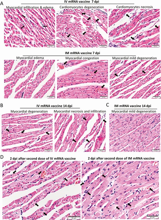 Histopathological changes in the heart at 7 and 14 dpi after first dose of IV or IM mRNA vaccine and 2 dpi after second dose of vaccine. Groups of mice were given IV and IM vaccine or NS as control. At 7–14 dpi, mice were killed for histopathology. Another 2 groups of mice were given second dose of IV or IM mRNA vaccine at 14 days after the first priming dose and sacrificed at 2 dpi after the second boosting dose. A, Representative histopathological images of mouse heart at day 7. Top panel consisted of heart sections of IV group, which showed myocardial infiltration by white blood cells (left, arrows), interstitial edema, cardiomyocytes degeneration (middle, arrows) and necrosis (right, arrows). Lower panel consisted of heart sections from IM group, which showed myocardial interstitial edema (left) and myocardial vascular congestion (middle, arrows), with degeneration of a few cardiomyocytes (right, arrows). B, Representative histopathological images of IV and IM group at day 14. Heart in IV group showed persistent changes of cardiomyocyte degeneration, white blood cell infiltration, and foci of necrosis (arrows). C, Heart of mice in IM group showed minimal degeneration and infiltration but no necrosis. D, Representative histopathological images of the heart at 2 dpi after the second boosting dose given on day 14 after the first priming dose. Mouse heart in both IV and IM second dose group showed interstitial edema and diffuse cardiomyocyte degeneration on the left (arrows). Mouse heart in both IM and IV group showed diffuse inflammatory infiltrate, focal hemorrhage and necrosis (arrows, right). E. Serum cytokine/chemokine concentrations at 2 dpi post second dose were detected by beads-based multiplex flow cytometer assay. The NS group was used as control. Error bars indicated mean ± standard deviation. n = 5 each group. n = 9 for IV second dose boost group, n = 6 for IM second dose boost group and NS control group. *P < .05, **P < .01, ***P < .001 by multiple t test. Abbreviations: dpi, days post-injection; IM, intramuscular; IV, intravenous; mRNA, messenger RNA; NS, normal saline; RT-qPCR, reverse transcription quantitative polymerase chain reaction.