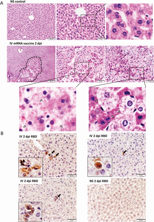 Histopathological changes in the liver at 2 dpi after IV mRNA vaccine injection. A, Representative H&E images of liver sections. Images in the upper panel show the liver section of NS control mice, with normal morphology of evenly distributed cords of hepatocytes. Lower panel consisted of images of liver at 2 dpi in IV group. The liver showed diffuse degeneration of hepatocytes without a clear morphological organization of hepatic cords. A large focus of cell necrosis was circled by the dashed line. Magnified images (400× magnification) of hepatocyte necrosis (middle panel, arrows in magnified box of left bottom panel) and ballooning degenerative changes of hepatocytes (right panel, arrows in magnified box of right bottom panel). B, Images of immunohistochemistry stained spike RBD in liver sections at 2 dpi after IV vaccine. A few RBD positive cells were indicated by arrows in the inserts (400× magnification). Abbreviations: dpi, days post-injection; H&E, hematoxylin and eosin; IV, intravenous; mRNA, messenger RNA; NS, normal saline; RBD, receptor binding domain.
