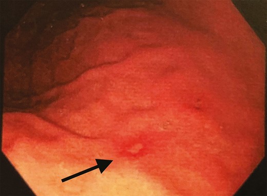 Esophagogastroduodenoscopy demonstrated multiple erosions within surrounding erythema along the gastric body and antrum. Histopathology of these lesions demonstrated eosinophilic infiltration consistent with anisakidosis.