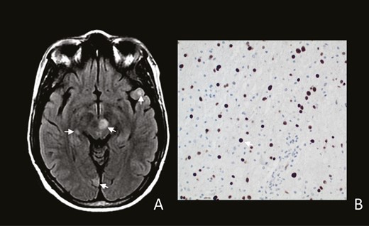A, MR-FLAIR sequences with multiple areas of increased signal involving medial midbrain (arrow), left thalamus and right putamen with scattered smaller lesions (arrows). B, Brain biopsy showing oligodendrocyte nuclei staining positive for J-C virus (arrow) (Sv40 immunostain 200×).