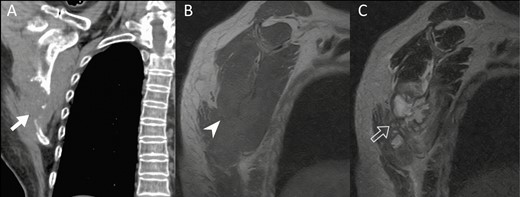Image findings of case patient with exclusively musculoskeletal cryptococcosis. A, Non–contrast-enhanced computed tomography image shows a destructive osteolytic lesion (solid arrow) in the right lower scapular body. B, Sagittal oblique magnetic resonance imaging of right shoulder reveals an osteolytic isointense soft tissue lesion (arrowhead) on T1-weighted magnetic resonance imaging (MRI). C, A lobulated hyperintense lesion (open arrow) is shown on T2-weighted MRI.