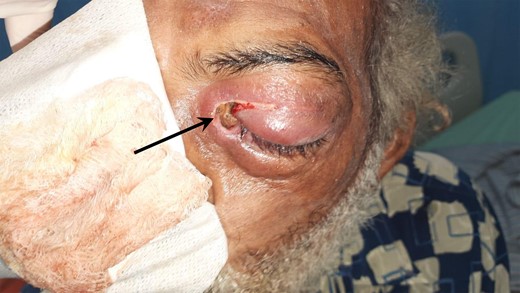 Enlarged left orbit with bi-palpebral edema, swollen and erythematous periorbital tissues, and live larvae coming out of the eye socket (arrow).