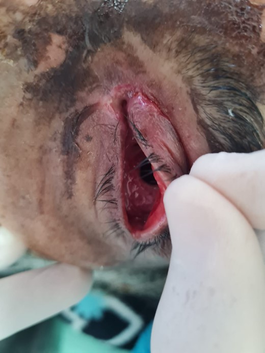 Complete enucleation of the left eyeball. The surgical wound was left open for cleaning.