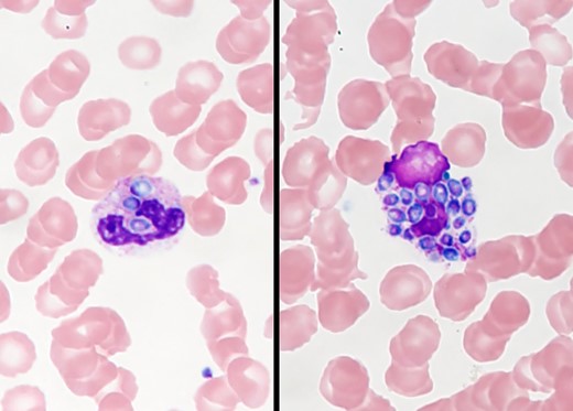 Peripheral blood smear findings on admission.