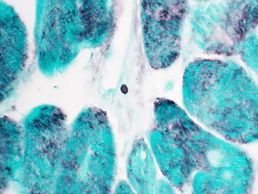 GMS stain of cardiac biopsy showing rare small oval yeast consistent with Histoplasma capsulatum (100× magnification).