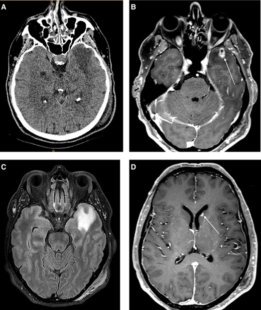 A, Non-contrast CT demonstrated an area of hypoattenuation with mild mass effect in the left anterior temporal lobe. B, MRI brain, T1 post contrast sequence demonstrated a 15 mm enhancing lesion in the left anterior temporal lobe with small area of central non-enhancement. C, FLAIR sequence showing moderate perilesional oedema. D, T1 post contrast sequence depicting a smaller enhancing lesion in the left caudate head. Abbreviations: CT, computerized tomography; MRI, magnetic resonance imaging.