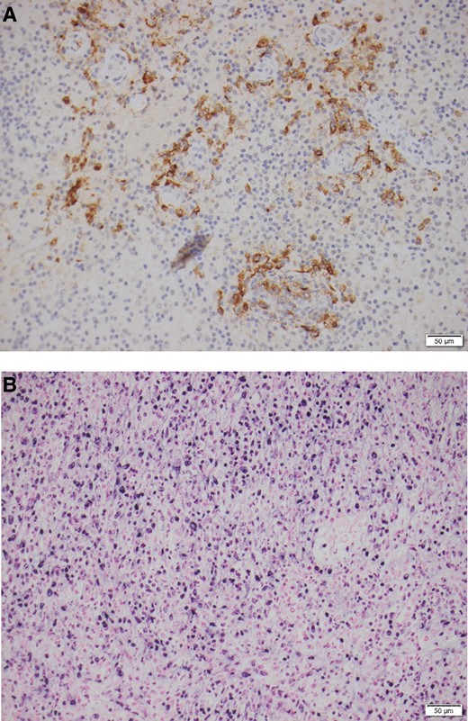 A, Histopathology of temporal mass lesion, showing lymphohistiocytic inflammatory reaction with focal necrosis. B, EBER ISH of the temporal mass lesion. Abbreviations: EBER, Epstein-Barr encoding region; ISH, in situ hybridization.