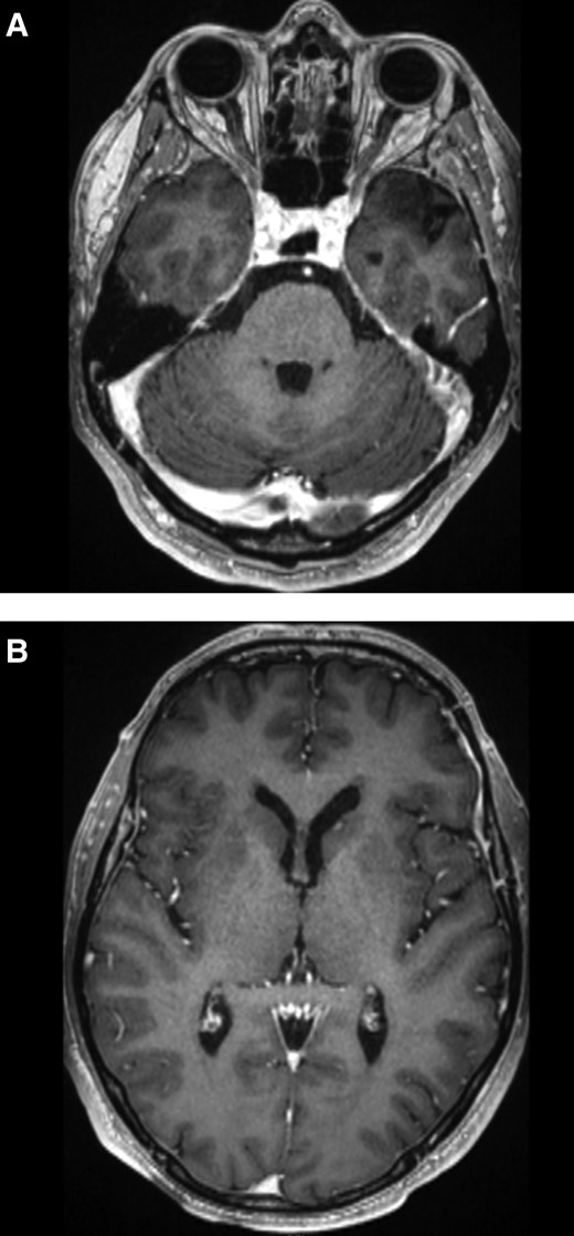 MRI brain post-treatment. A, T1 post contrast sequence demonstrating no residual enhancement at the resection site. B, T1 post contrast sequence demonstrating a tiny focus of enhancement in the left caudate head. Abbreviation: MRI, magnetic resonance imaging.