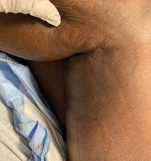 Large indurated plaque with overlying erythema of the posterior left thigh.