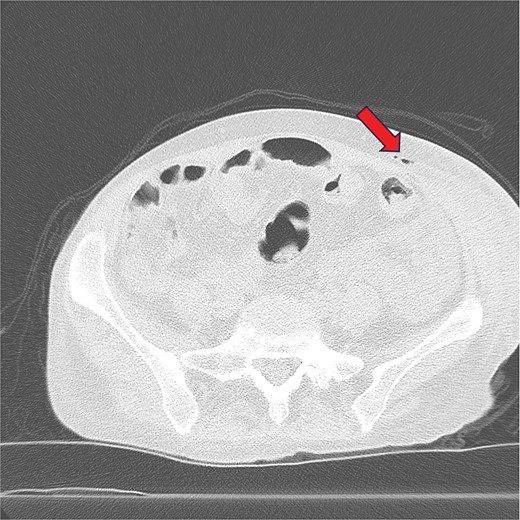 Infiltrative fluid collection in the left lower quadrant abdominal wall with small foci of internal gas.