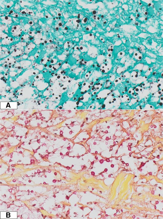 A, Grocott's methenamine silver stain. B, Mucicarmine stain.