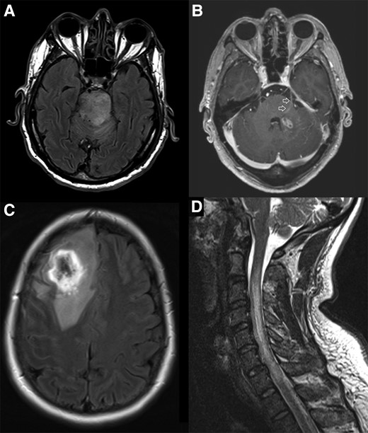 Magnetic resonance imaging from cases in this cohort highlighting selected features of CNS melioidosis. A, MRI FLAIR sequence demonstrating hyperintense expansile lesion within the brainstem extending into the left middle cerebellar peduncle and cerebral peduncles bilaterally. The patient presented with pneumonia and bacteremia, with neurological symptoms developing subsequently; the Burkholderia pseudomallei isolate carried the bimABm allele. B, MRI T1 post-contrast study demonstrating small, ovoid lesion with rim enhancement in the left cerebellar peduncle and enhancement of the adjacent trigeminal nerve and tract as it traverses the pons (arrows). The patient had a neurological presentation; the B. pseudomallei isolate carried the bimABm allele. C, MRI FLAIR sequence demonstrating a very hyperintense ring lesion with extensive increased signal in adjacent white matter consistent with vasogenic edema. The patient presented with pneumonia and seizures; it was not possible to determine the bimA allele in this case. D, MRI T2 sequence demonstrating cord expansion with high signal from the C2/3 to C7/T1 level. The patient had a neurological presentation; the B. pseudomallei isolate carried the bimABm allele. Abbreviations: CNS, central nervous system; FLAIR, fluid attenuated inversion recovery; MRI, magnetic resonance imaging.