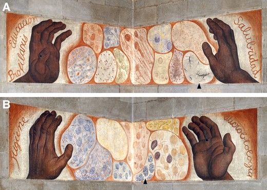 Microbial Flora (fresco), Ministry of Health, Mexico City. A, “Education and Prophylaxis” (left), “Public Health” (right). The arrowhead points to potential Salmonella Typhi (see also Figure 2A). B, “Hygiene” (left), “Microbiology” (right). The arrowhead points to gram-positive diplococci within phagocytes. In both panels, some bacteria are free in the tissues; others are associated with or within phagocytes (B, arrowhead). Image was provided by ©Bob Schalkwijk. Reproduced with permission from Banco Mexico Diego Rivera Trust, Mexico, DF/Artists Rights Society, New York.