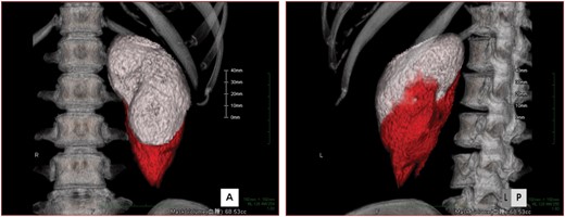 Calculation of the renal volume and bleeding volume after biopsy. The renal area (white) and bleeding area (red) are shown in 3D volume rendering in (A) frontal view and (B) left-posterior view.