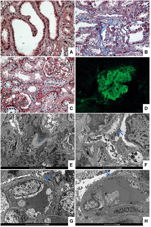 Light and immunofluorescence microscopy. (A) Hematoxylin and eosin, magnification × 40, observing focal tubular dilatation. (B and C) Masson's trichrome and periodic acid–Schiff stains, magnification × 40, showing a thin glomerular basement membrane with mild increasing of the mesangial matrix and cellularity. (D) Direct immunofluorescence for immunoglobulin M presenting diffuse mesangial staining. Electron microscopy. (E) Discrete increasing of the mesangial matrix (see asterisk). (F, G and H) Diffuse and severe foot process effacement (see arrows).