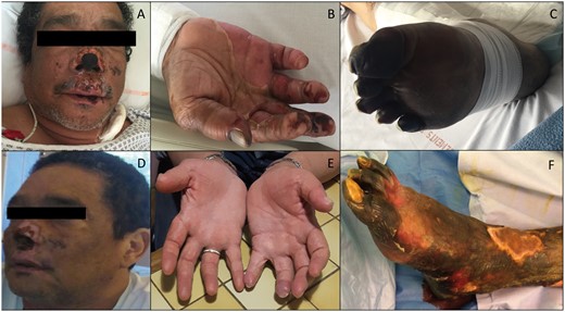 (A–C) Skin damage to the face (A), hands (B) and feet (C) of the acute phase of SP-HUS. (D, E and F) The respective evolution at 2 months with partial destruction of the nose wing cartilages (D), complete recovery on the hands (E) and severe necrosis of the legs (F), which led to trans-tibial amputation at 3 months.