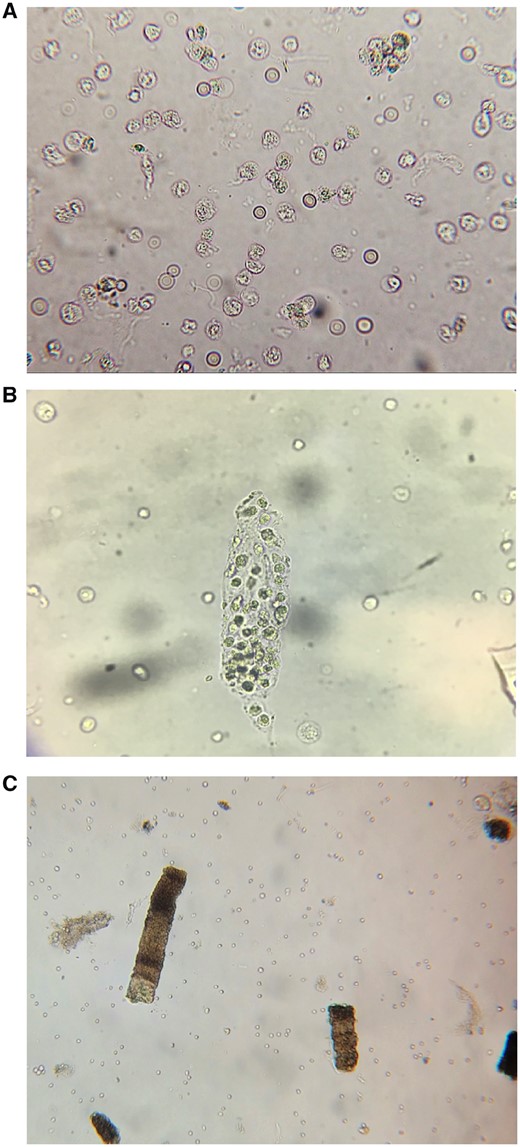 Urine microscopy findings in AIN. (A) WBCs and RBCs. (B) WBC cast. (C) Granular ‘muddy brown’ casts.