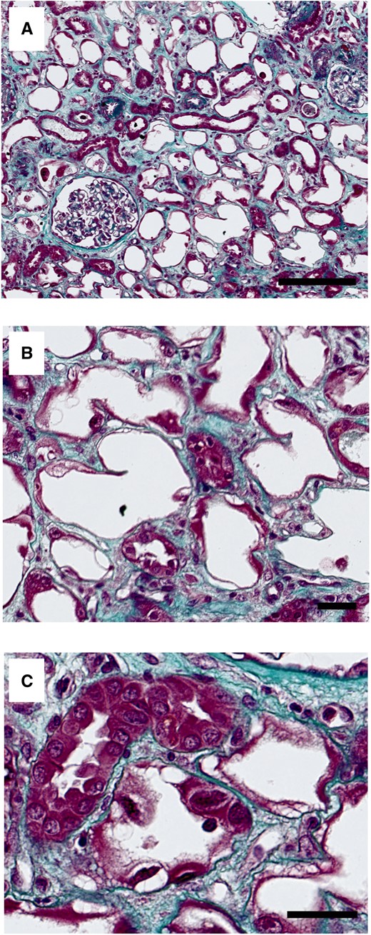 Masson’s trichrome staining of kidney biopsy showing (A) diffuse tubular denudation at low magnification (scale bar, 250 µm). At higher magnification, Masson’s staining showing (B) denudation of proximal tubular epithelium with loss of brush border (scale bar, 50 µm) and (C) vacuolization of epithelial cells and nuclear atypia (scale bar, 50 µm).