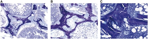 Histological changes throughout treatment. Bone biopsies stained with Toluidine Blue dramatic reduction in osteoid thickness following phosphorus supplementation. (A) Bone biopsy in 2015 with large amounts of osteoid tissue. (B) Bone biopsy in 2016 after optimized 25(OH)-vitamin D and Calcium supplementation with no improvement. (C) Bone biopsy in 2017 after phosphorus supplementation showing the mineralization of osteoid tissue.