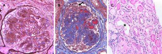Renal biopsy micrographs for Patient 2 showing diabetic nephropathy and focal and segmental sclerosis with collapsing features. Renal biopsy reveals underlying diffuse and nodular diabetic glomerulosclerosis (A, Jones methenamine silver 600×). There were lesions of segmental sclerosis with focal collapsing features (B, Trichrome stain 600×) characterized by capillary luminal obliteration by insudates and segmental tuft deflation, with overlying podocyte hyperplasia and prominent cytoplasmic vacuolization (black arrow). There was also concomitant acute tubular necrosis (C, asterisk, hematoxylin and eosin, 200×), with interstitial edema and a mixed interstitial inflammatory infiltrate (interstitial nephritis).