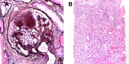 Renal biopsy micrographs for Patient 3 showing diabetic nephropathy and drug-induced acute interstitial nephritis. Renal biopsy revealed diffuse and nodular diabetic glomerulosclerosis (A, Jones methenamine silver 600×). There were diffuse interstitial edema and extensive interstitial inflammation (B) with associated tubular inflammation and acute necrosis, consistent with interstitial nephritis.
