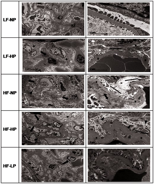 Glomerular lesions observed by TEM in rats fed diets with LF–NP, LF–HP, HF–NP, HF–HP and HF–LP. In ultrastructure, changes like podocyte hypertrophy (thin arrow), focal podocyte injury: fractional foot process effacement (solid line) and microvillus transformation (arrow head), increased mesangial matrix (arrow), glomerular basement membrane thickening (asterisks) and capillary remodeling identified as double contours (hash) were more evident in the HF and HP groups.