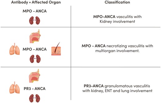 Proposed classification of AAV kidney disease. Proposed classification according to ANCA type and organ involvement. Providing direct information about prognosis, severity, risks of relapse, type of treatment required and likelihood of response. ENT, ear, nose, throat.