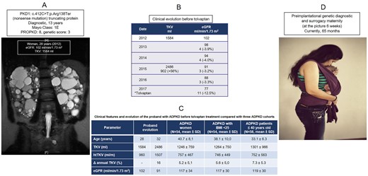 A) Coronal T2-weighted MRI scan of the abdomen in the proband at the age of 28 years showing a total kidney volume (TKV) of 1584 ml and TKV adjusted by height (htTKV) of 960 ml/m. Combined imaging, eGFR and genotype findings. B) Clinical evolution of the proband before tolvaptan. C) Clinical evolution of the proband compared with three ADPKD cohorts. D) Result of PGD and GS.
