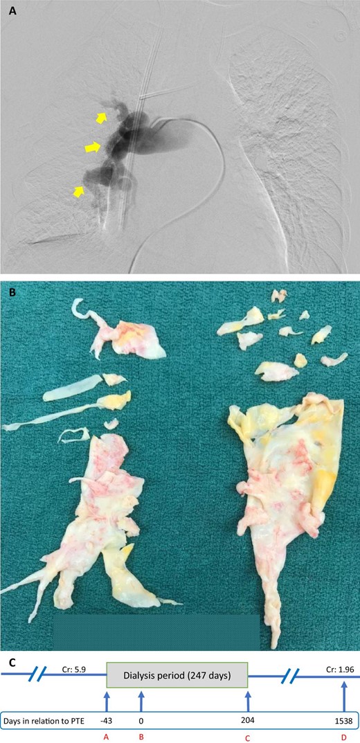 (A) Pre-operative right pulmonary artery angiogram of Case 2. Arrows point to occlusions of the pulmonary artery leading to pulmonary hypoperfusion. (B) Specimen retrieved from PTE of Case 2. (C) A timeline of Case 2. A indicates initiation of dialysis; B indicates day of PTE; C indicates last day of dialysis; D indicates last day of follow-up. Cr, creatinine (mg/dL).