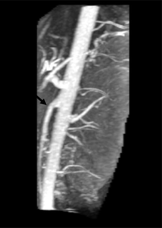 Lateral reconstruction of magnetic resonance imaging showing acute angle and narrow space (arrow) between superior mesenteric artery and aorta.
