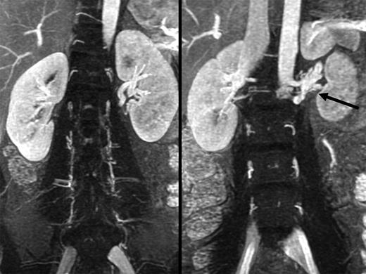 Composite coronal venous phase magnetic resonance angiogram images showing kidneys of equal size with venous congestion at the hilum of the left kidney. Congested partially obstructed left renal veins (arrow) are shown at the lateral margin of the aorta with poorly developed collaterals to lumbar veins. The absence of either a lieno-renal pathway or an incompetent ovarian vein may explain the severity of her symptoms.