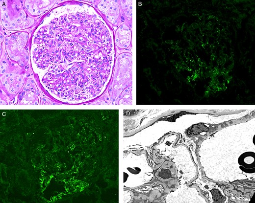 Kidney biopsy: (A) Light microscopy: A glomerulus with mild mesangial sclerosis and hypercellularity, and mild thickening of glomerular capillary wall (Periodic acid–Schiff stain, ×400). (C) Immunofluorescence studies: Punctate staining of IgG (B) and C4d (C) along the glomerular capillaries and in mesangial areas (direct immunofluorescence, ×400). (D): Electron microscopy: Rare small electron-dense deposits are noted in the subendothelial and mesangial locations. There is mild mesangial sclerosis. Indentation of the glomerular basement membrane is also noted in a rare glomerular capillary (×3000).