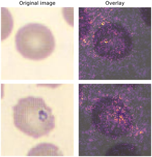 Visual example of explainable AI using integrated gradients (IG). Original peripheral blood smear was created and imaged on a DI-60 Integrated Slide Processing System (Cellavision AB) using a 100×-objective and a 0.5× magnifier for an effective magnification of 50×. Images are 70 × 70 (height × width) with 3-channel RGB, and a resolution of 5 pixels per micron. The top row represents a normal cell, which was classified by an ML model as normal (i.e., true negative). The bottom row represents an erythrocyte with a Babesia spp inclusion and was classified by a ML model as a parasite (i.e., true positive). The IG method highlights pixels in each image that appeared to most heavily influence the model prediction. Highlighted pixels are then pseudocolored using an intensity scale (e.g., greater influence on class prediction = brighter) and subsequently overlaid on the original image (right-most column).