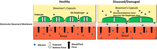 Mechanism of albuminuria for the podocyte injury theory. Healthy podocytes have increased slit diaphragm regions which small molecule solutes are able to pass through. Injured podocytes have rounded processes and a shortened slit diaphragm resulting in decreased buttress forces and a reduction in the slit area reducing glomerular ultrafiltrate. This increases albumin permeability and allows more albumin to pass into the urine with a simultaneous reduction of small molecule filtration.