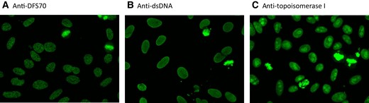 IIF of selected samples. IIF images of sera with anti-DFS70 antibodies (A), anti-dsDNA antibodies (B), and antitopoisomerase antibodies (C). The IIF substrate used was NOVA Lite DAPI ANA Kit, Werfen) on NOVA View (Werfen). The assay for anti- DFS70/LEDGFp75 antibodies was QUANTA-Flash DFS70 CLIA.