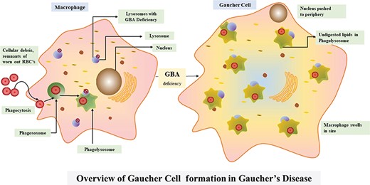 Overview of the Gaucher disease pathway.