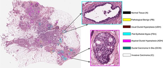 Example of a WSI and its associated ROIs. A fixed palette is used to mark the tumor subtype of the lesion.