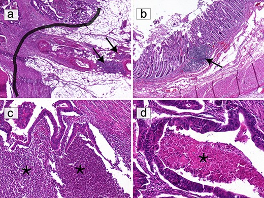 Selection of areas for T-cell quantification on HE slides. (a) Only T lymphocytes in direct contact with the IM (black border) were quantified. Lymphocytic infiltration beyond the IM, including lymphoid nodules (black arrows), was excluded (HE ×40). (b) Submucosal lymphoid follicles (black arrows) were not included in the count (HE ×40). (c) The infiltrate composed of granulocytes in abscessed areas (*) was not considered (HE ×100). (d) Areas of ‘necrosis’ (*) were not taken into consideration (HE ×200).