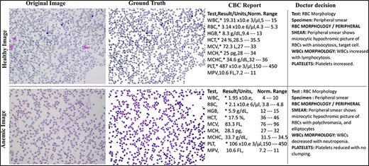 Original and RGB segmented ground truth samples of healthy and anemic images including original, ground truth, CBC report, and doctor decision in AneRBC-I dataset.