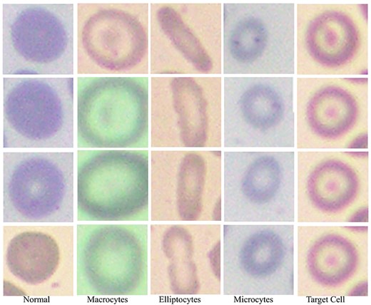 Red blood cells in the anemic images can be classified as normal, macrocytes, elliptocytes, microcytes, and target cells.