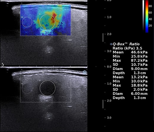 Measurement of SWE quantitative indicators. SWE, shear wave elastography.
